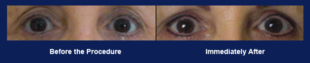 Permanent Makeup - Eyebrows
